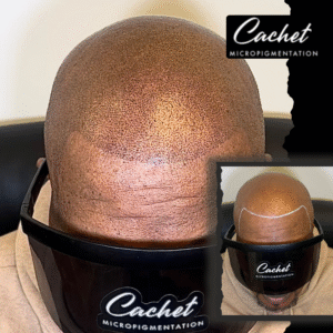 HAIRLINE RESTORATION